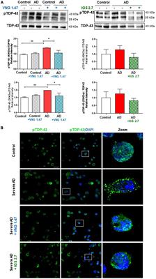 TTBK1 and CK1 inhibitors restore TDP-43 pathology and avoid disease propagation in lymphoblast from Alzheimer’s disease patients